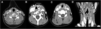 Multimodal imaging of congenital pyriform fossa fistula in children